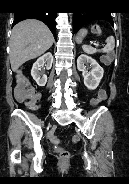 File:Appendiceal hemorrhage (Radiopaedia 70830-81025 C 47).jpg