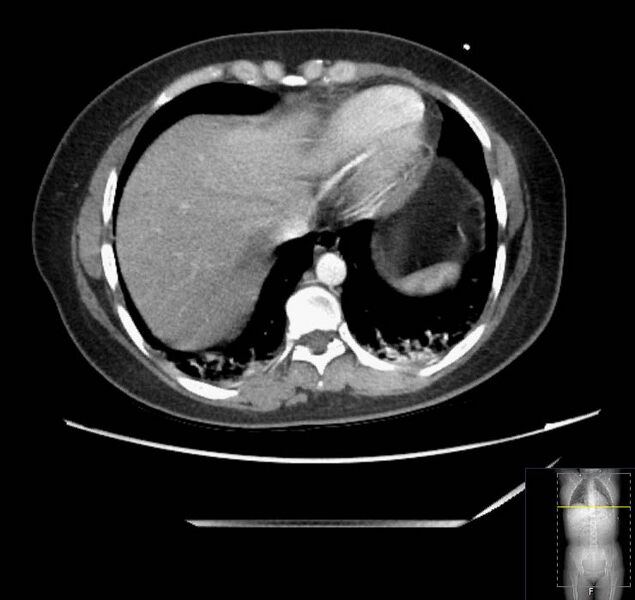 File:Appendicitis (CT angiogram) (Radiopaedia 154713-127660 Axial 175).jpg