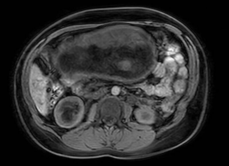 File:Appendicitis in gravida (MRI) (Radiopaedia 89433-106395 Axial DIXON 59).jpg