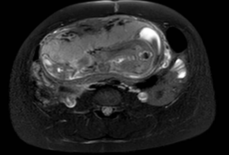 File:Appendicitis in gravida (MRI) (Radiopaedia 89433-106395 Axial T2 SPAIR 41).jpg