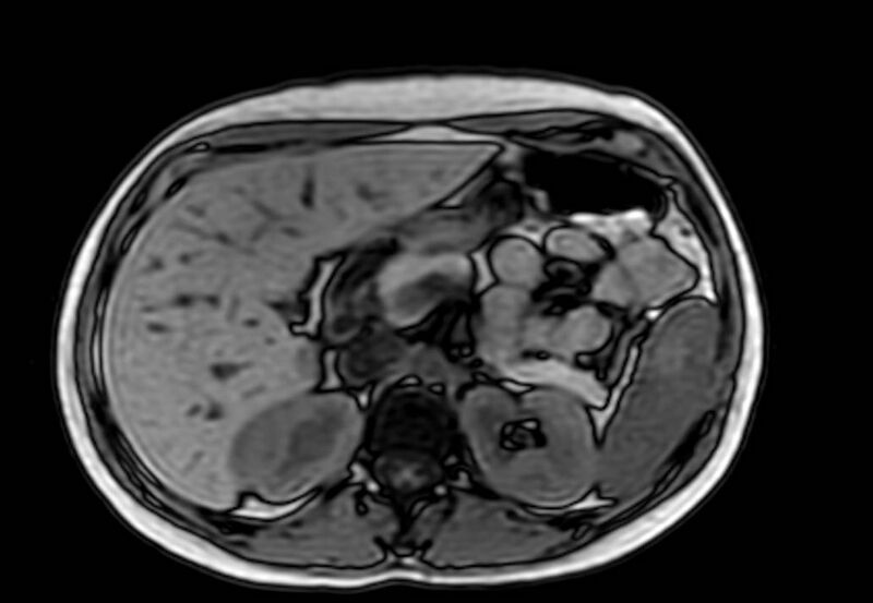 File:Appendicitis in gravida (MRI) (Radiopaedia 89433-106395 D 17).jpg