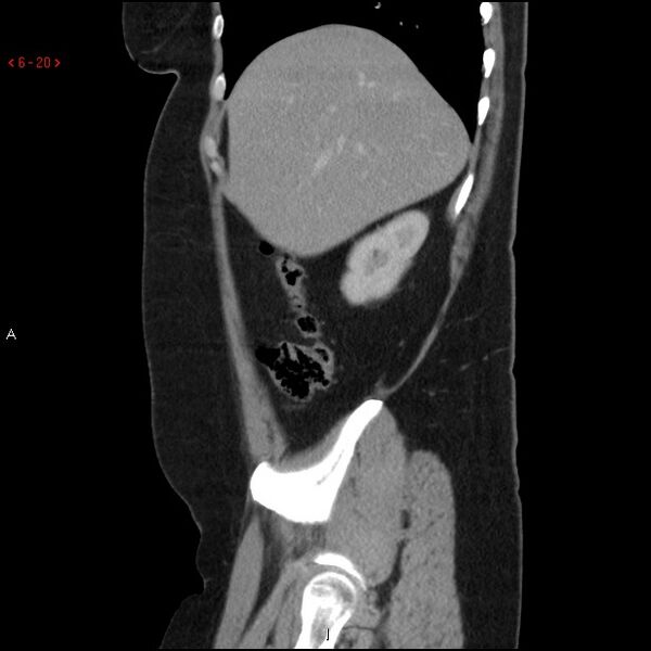 File:Appendicitis with microperforation- promontoric type (Radiopaedia 27268-27442 A 5).jpg