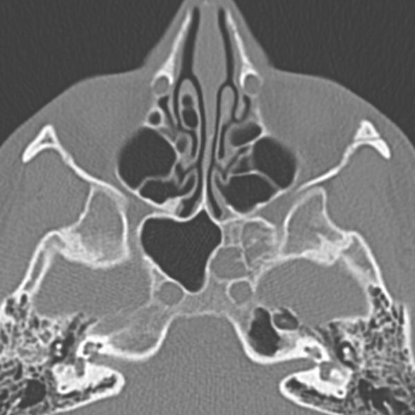 File:Arrested pneumatization of the sphenoid (Radiopaedia 10700-11172 Axial non-contrast 4).jpg