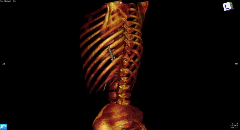 File:Arrow injury to the chest (Radiopaedia 75223-86321 3D bone 15).jpg