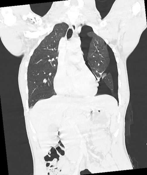 File:Arrow injury to the chest (Radiopaedia 85367-100975 Coronal lung window 68).jpg
