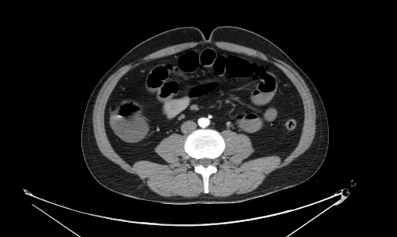 File:Arterial occlusive mesenteric ischemia (Radiopaedia 84641-100060 A 76).jpg