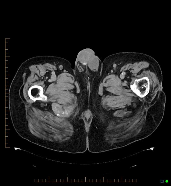 File:Artificial urethral sphincter (Radiopaedia 46937-51464 A 16).jpg