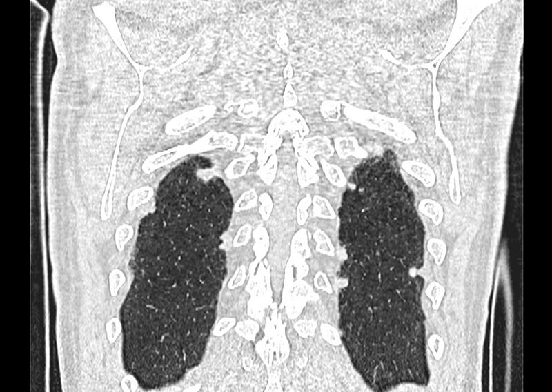 File:Asbestos pleural placques (Radiopaedia 57905-64872 Coronal lung window 262).jpg