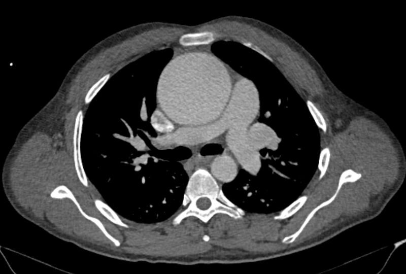 File:Ascending aortic aneurysm (Radiopaedia 86279-102297 C 22).jpg