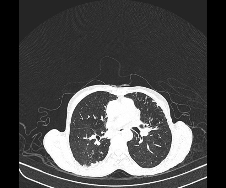 File:Aspergillomas (Radiopaedia 66779-76110 Axial lung window 24).jpg
