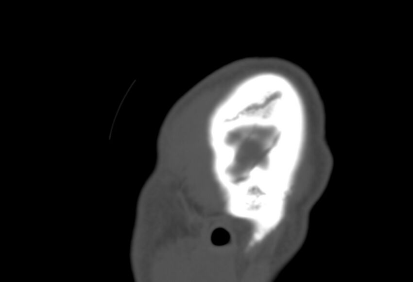 Asymptomatic occipital spur (Radiopaedia 87753-104201 Sagittal bone window 306).jpg