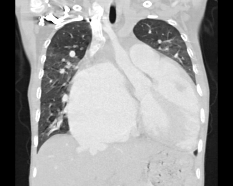 File:Atrial septal defect complicated by Eisenmenger syndrome (Radiopaedia 53707-59768 Sagittal lung window 11).jpg