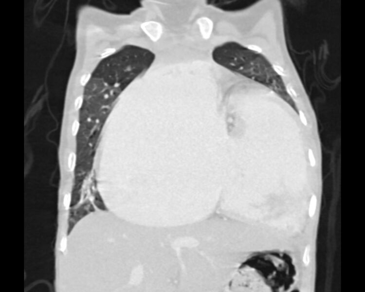 File:Atrial septal defect complicated by Eisenmenger syndrome (Radiopaedia 53707-59768 Sagittal lung window 8).jpg