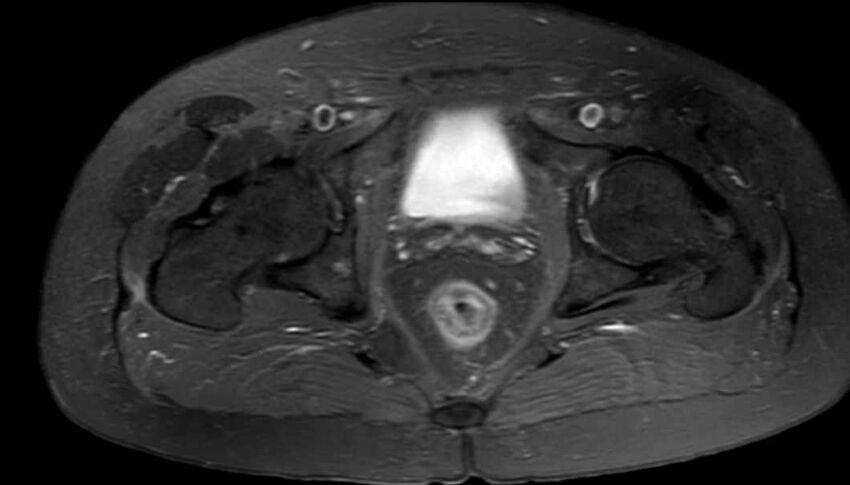 Atypical lipomatous tumor - thigh (Radiopaedia 68975-78734 Axial PD fat sat 91).jpg
