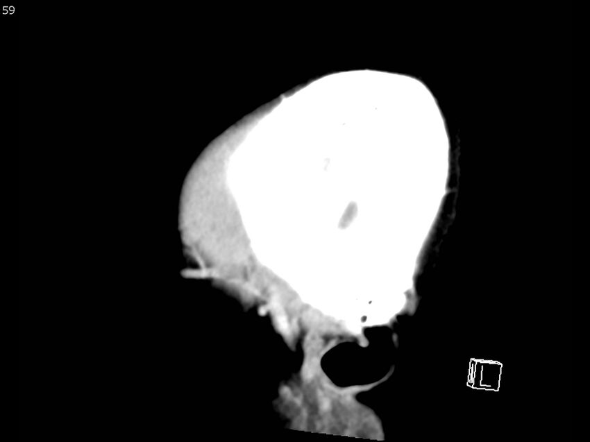 Atypical meningioma - intraosseous (Radiopaedia 64915-73867 F 58).jpg