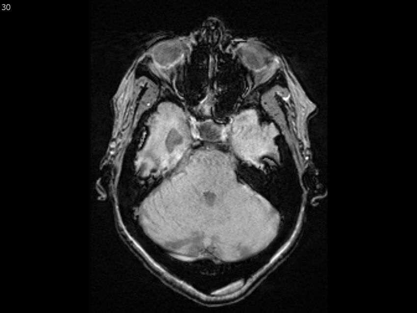Atypical meningioma - intraosseous (Radiopaedia 64915-74572 Axial SWI 30).jpg