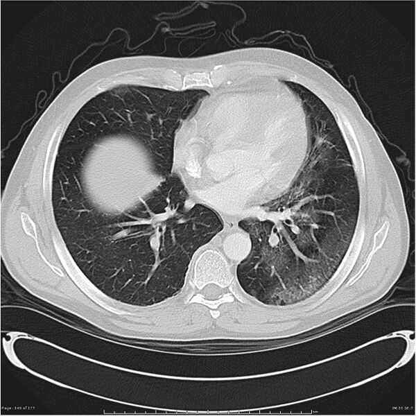 File:Atypical pneumonia - Q fever (Radiopaedia 21993-21989 lung window 28).jpg