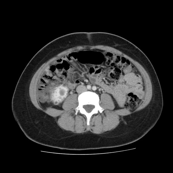 File:Autosomal dominant polycystic kidney disease (Radiopaedia 23061-23093 C 40).jpg
