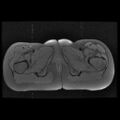 Avascular necrosis of the hip (Radiopaedia 29563-30067 Axial T1 fat sat 16).jpg