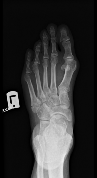 File:Avulsion fracture of the 5th metatarsal styloid - pseudo-Jones fracture (Radiopaedia 61218-69121 Frontal 1).PNG