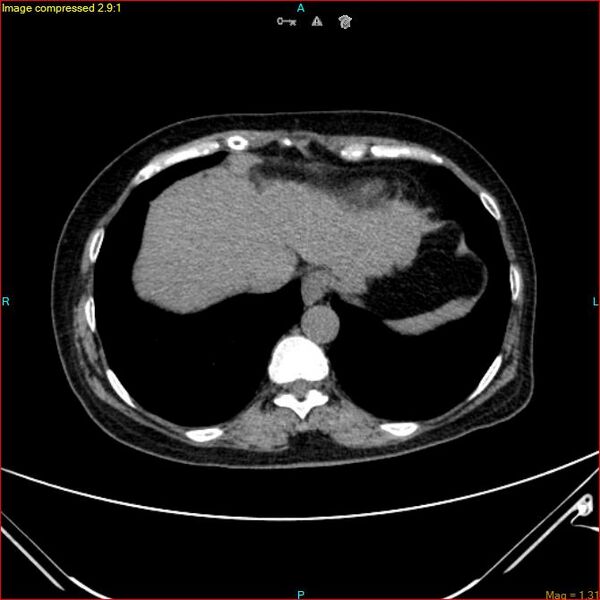 File:Azygos vein aneurysm (Radiopaedia 77824-90130 A 45).jpg
