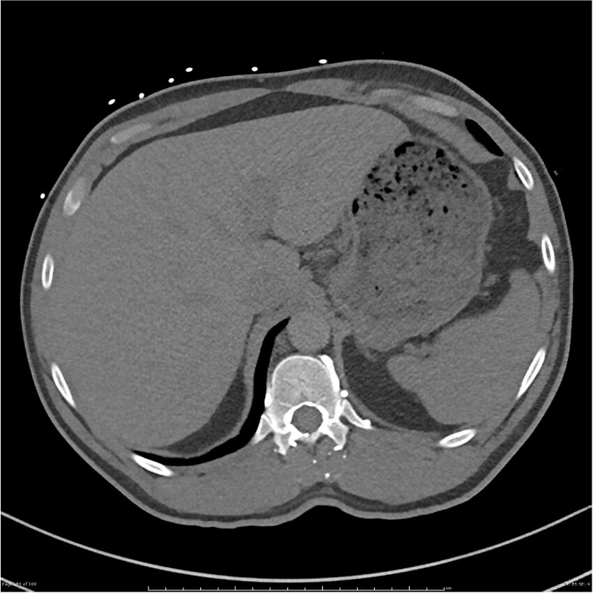 Azygos venous system anatomy (CT pulmonary angiography) (Radiopaedia 25928-26077 Axial C+ CTPA 85).jpg