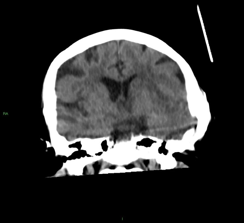 Basal ganglia hemorrhage (Radiopaedia 58790-66024 Coronal non-contrast 33).jpg