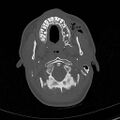 Base of skull fracture with bilateral Le Fort fractures (Radiopaedia 47094-51638 Axial bone window 15).jpg