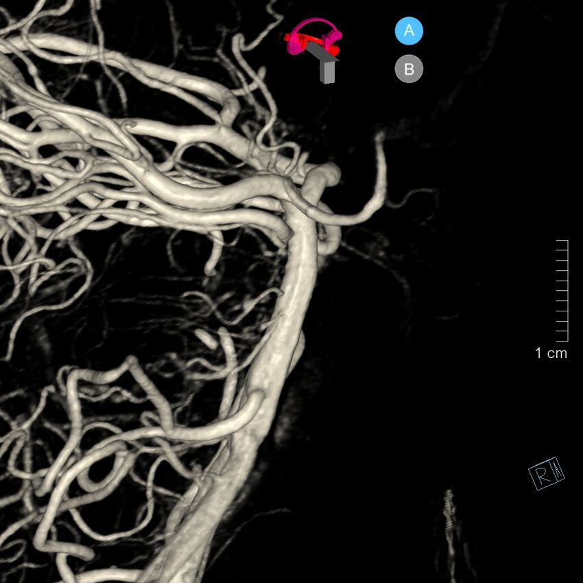 Basilar artery perforator aneurysm (Radiopaedia 82455-97734 3D view left VA 60).jpg