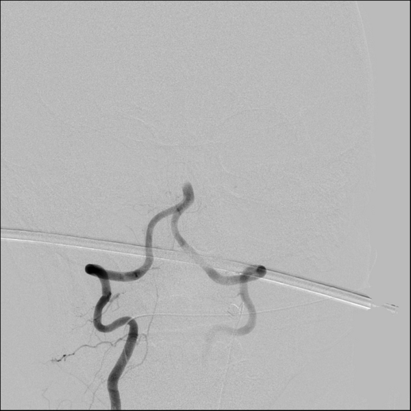 File:Basilar artery thrombosis treated with intra-arterial urokinase (Radiopaedia 34571-35949 A 14).png