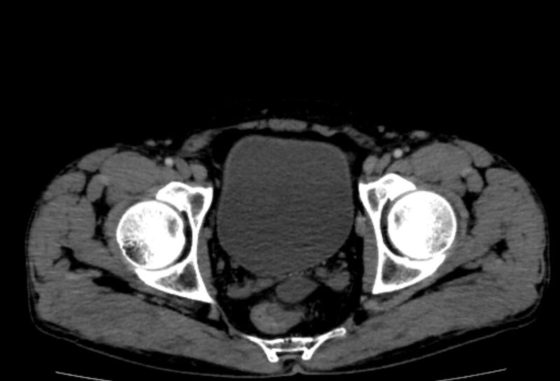 File:Behçet's disease- abdominal vasculitis (Radiopaedia 55955-62570 A 86).jpg