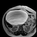 Benign seromucinous cystadenoma of the ovary (Radiopaedia 71065-81300 B 29).jpg