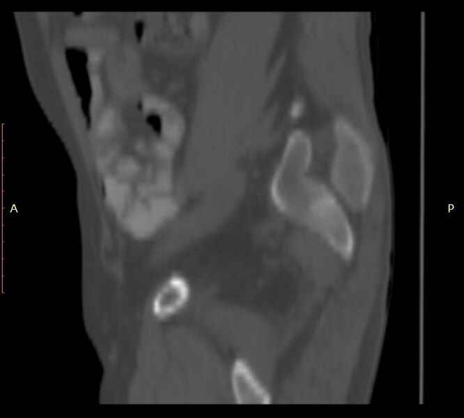 File:Bertolotti syndrome (Radiopaedia 58974-66235 Sagittal bone window 1).jpg