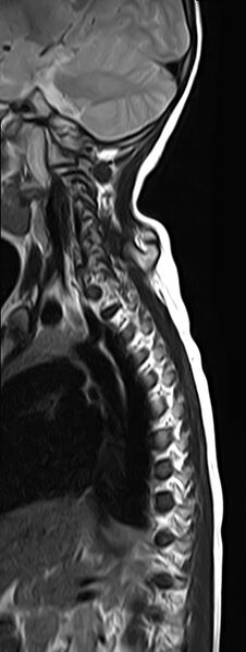File:Bilateral Sprengel deformity with Klippel-Feil syndrome (Radiopaedia 66395-75650 Sagittal T2 10).jpg