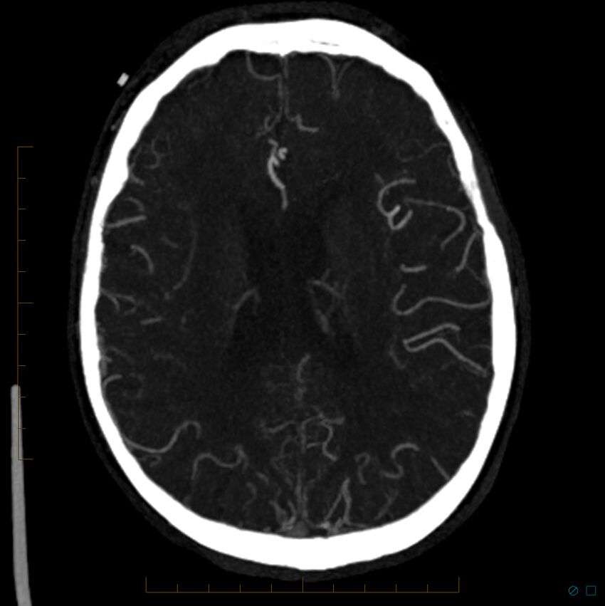 Bilateral chronic common carotid occlusion (Radiopaedia 50849-56362 D 12).jpg