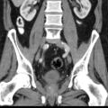Bilateral direct inguinal herniae (Radiopaedia 17016-16719 A 24).jpg