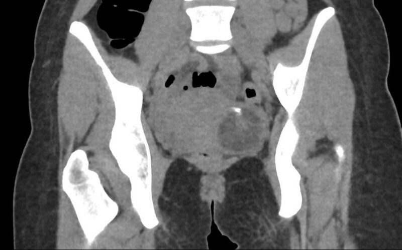 File:Bilateral mature cystic ovarian teratoma (Radiopaedia 88821-105592 Coronal non-contrast 17).jpg
