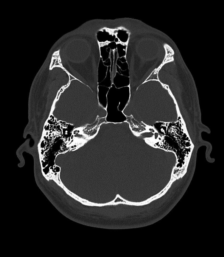 Bilateral medial canal fibrosis (Radiopaedia 85598-101344 Axial bone window 46).jpg