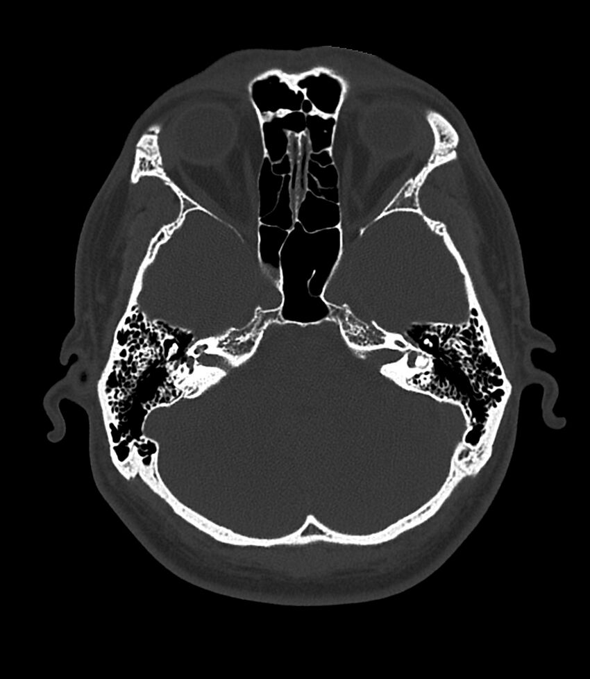 Bilateral medial canal fibrosis (Radiopaedia 85598-101344 Axial bone window 49).jpg