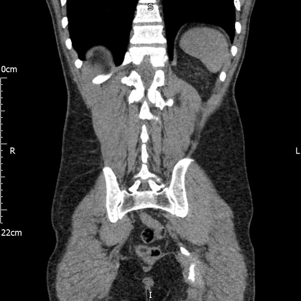 File:Bilateral medullary nephrocalcinosis with ureteric calculi (Radiopaedia 71269-81569 Coronal non-contrast 58).jpg