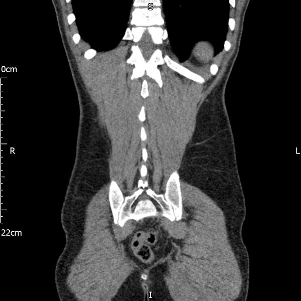 File:Bilateral medullary nephrocalcinosis with ureteric calculi (Radiopaedia 71269-81569 Coronal non-contrast 63).jpg