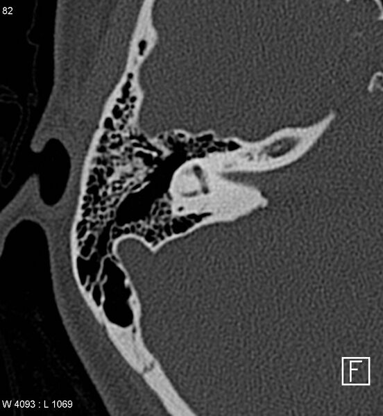 File:Bilateral otosclerosis with left stapes prosthesis (Radiopaedia 5567-7302 Axial bone window 14).jpg