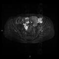 Bilateral ovarian fibroma (Radiopaedia 44568-48293 Axial STIR 9).jpg