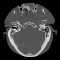 Bilateral perched facets with cord injury (Radiopaedia 45587-49713 Axial bone window 10).jpg