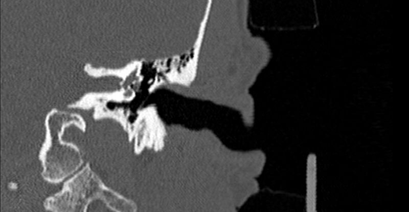 File:Bilateral temporal bone fractures (Radiopaedia 29482-29970 B 34).jpg