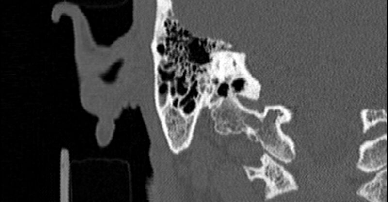 File:Bilateral temporal bone fractures (Radiopaedia 29482-29970 Coronal 90).jpg