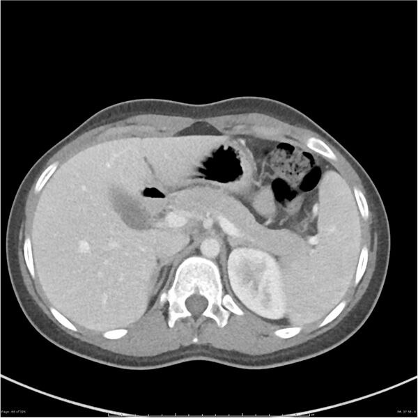 File:Bilateral ureteritis and cystitis (Radiopaedia 25340-25594 A 17).jpg