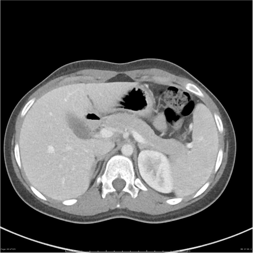 Bilateral ureteritis and cystitis (Radiopaedia 25340-25594 A 17).jpg