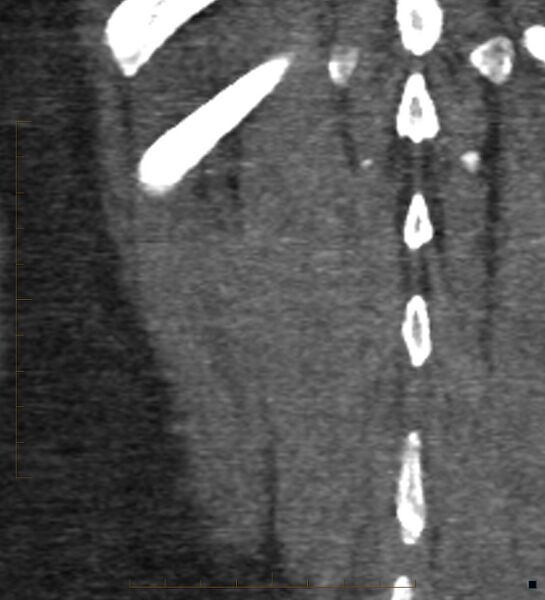 File:Bile leak from accessory duct(s) of Luschka post cholecystectomy (Radiopaedia 40736-43389 B 72).jpg