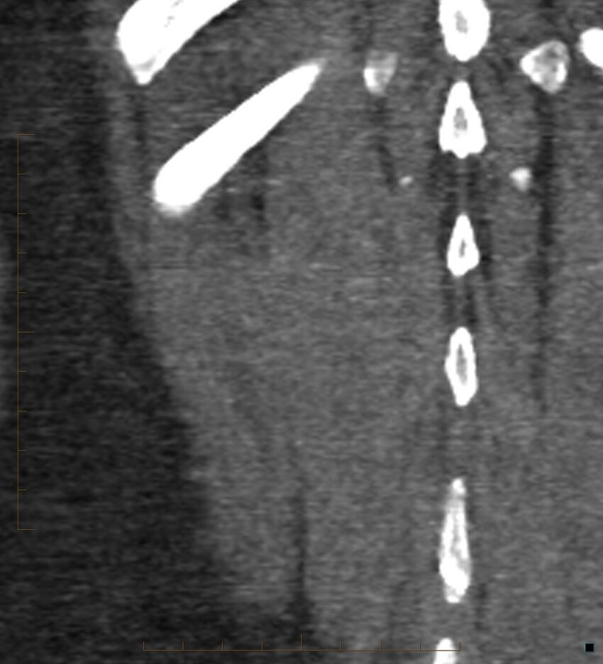 Bile leak from accessory duct(s) of Luschka post cholecystectomy (Radiopaedia 40736-43389 B 72).jpg